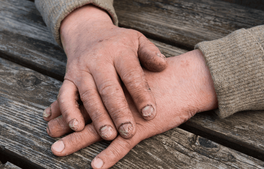 Fungal Infections on the Hands: Why They’re Often Misdiagnosed