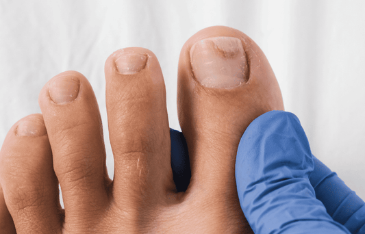 Is It Just Dry Skin Or a Fungal Infection on Your Hands or Feet?