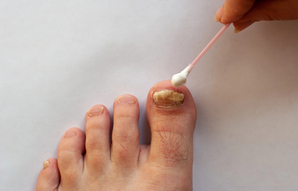 Non-medicated Fungal or Medicated Fungal: Which is Best for Nail Fungus Relief?