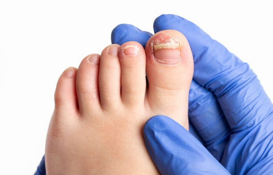 Nail Fungus vs. Skin Fungus: What’s Really Growing on Your Feet?