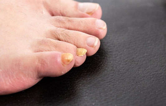 Is That Nail Discoloration a Fungus? Common Signs to Watch For