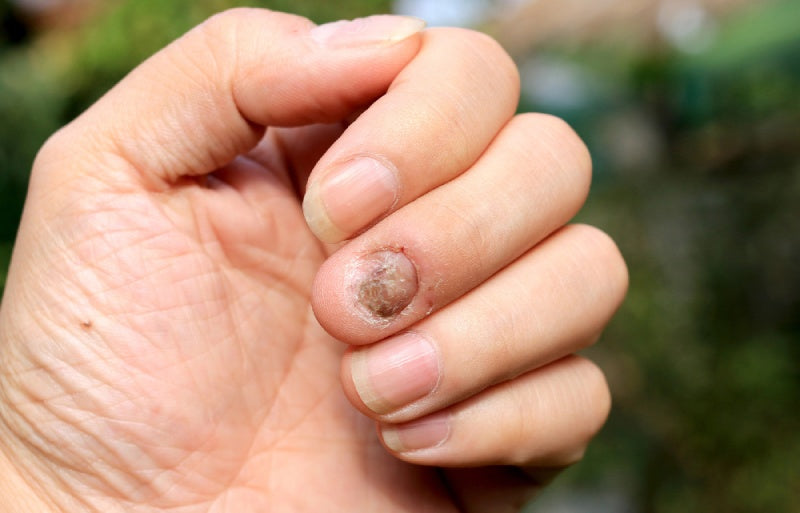 Can You Use Foot Fungus Cream on Your Hands? Here’s What to Know