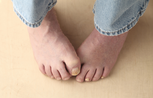 Why Topical Fungal Treatments Work Better for Nail Fungus and Athlete’s Foot