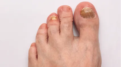 Toenail fungus